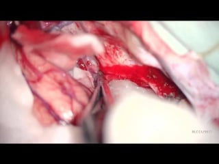 19 удаление менингиомы ольфакторной ямки