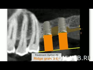 Bi directional augmentation of double arched posterior maxillary vertical defects