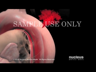 Aortic aneurysm and aortic dissection