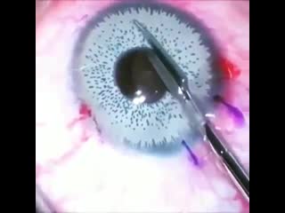 Iris colour implant due to chronic uveitis, glaucoma and cataract formation