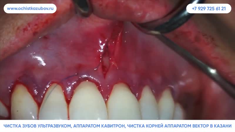 Чистка porn video – Ochistkazubov ru – чистка зубов вектором в казани