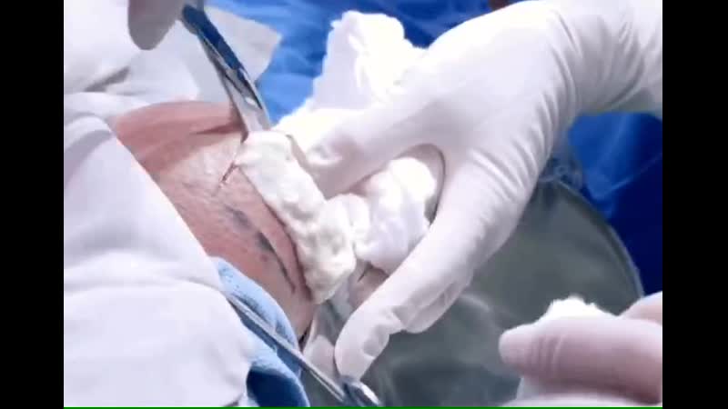 Киста коленного сустава