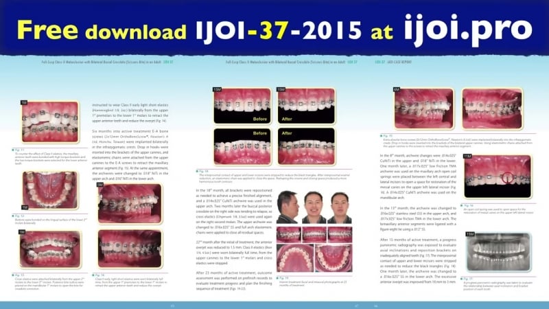 Chris top 11 cases full cusp cii malocclusion with bilateral buccal crossbite in an adult ортодонтия брекеты