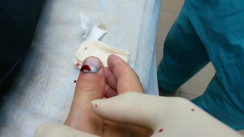 Лечение гематомы под ногтем