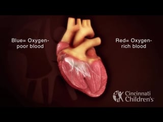 Atrioventricular septal defect av canal