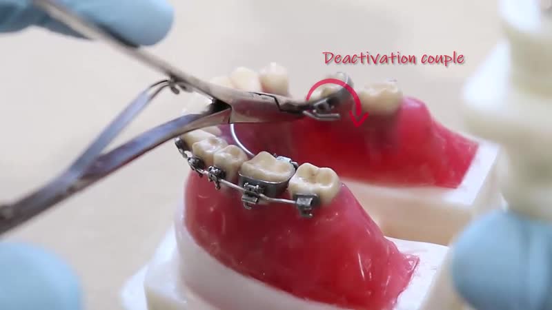 Lingual arch for molar uprighting ортодонтия