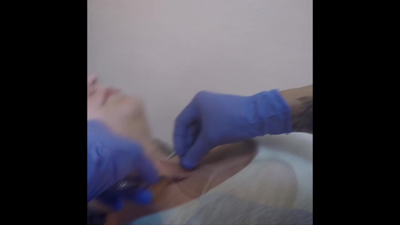 Устаноа микродермала