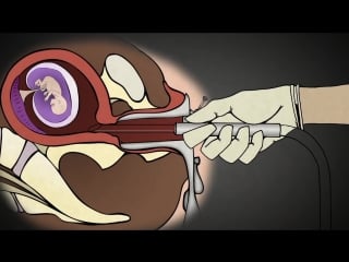 Аборт в анимации