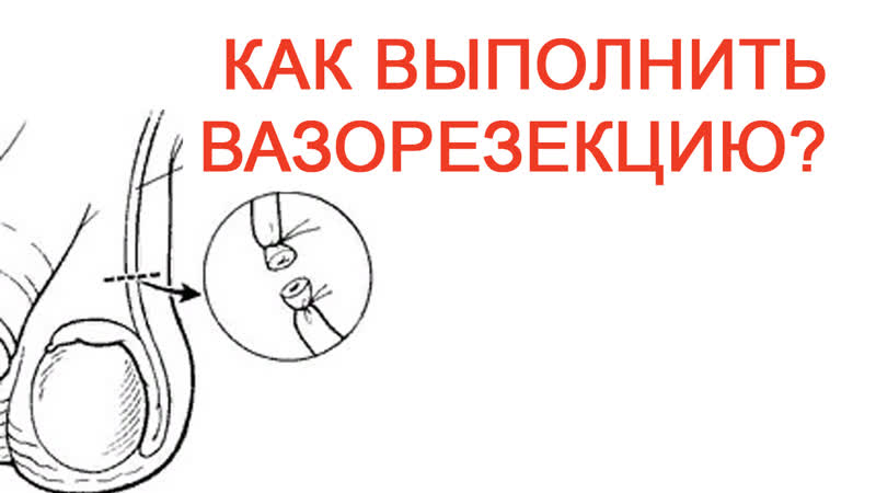 Как выполнить вазорезекцию?