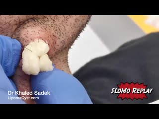 Ingrown hair cyst on jaw removed