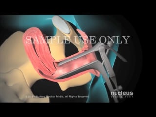 6 health literacy video dilation and curettage (d c)