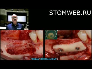 Alveolar ridge regenerative strategies autogenous bone vs bmp 2