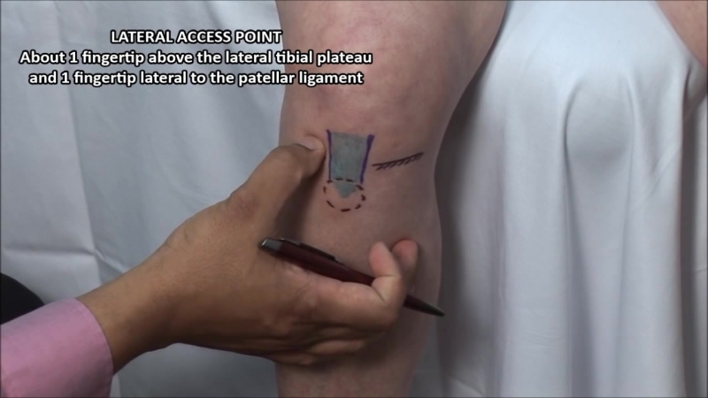 Инъекция в коленный сустав передний доступ