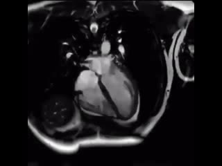 Динамический мрт сердца