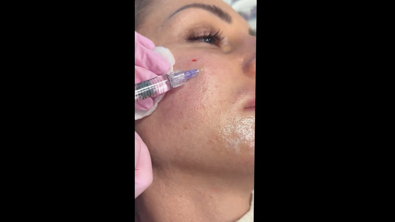 Коррекция рубцов