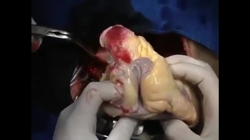 Хирурги показали, как происходит пересадка сердца