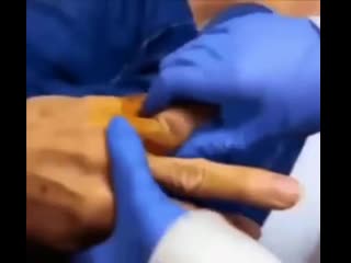 Вправление вывиха