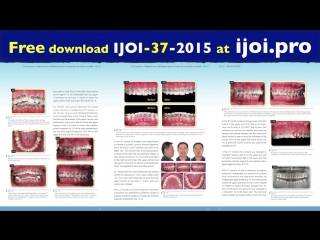 Chris top 11 cases full cusp cii malocclusion with bilateral buccal crossbite in an adult ортодонтия брекеты