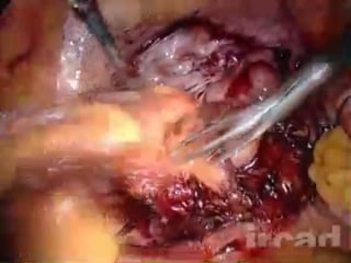 Laparoscopic sigmoidectomy for diverticulitis with associated hysterectomy laparoscopic surgery on the e surgical reference