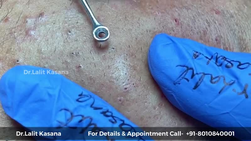 Выдавливание черных точек инструментом и ватными палочками