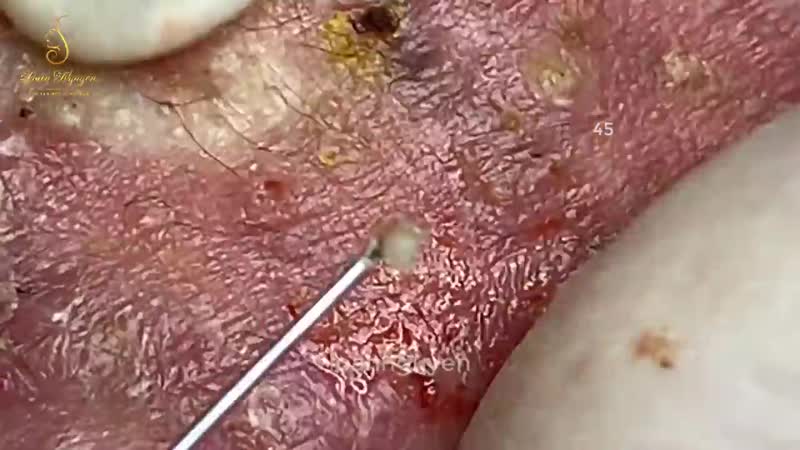 Инфицированное акне (прыщи, воспаления)