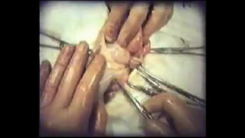 Аппендэктомия