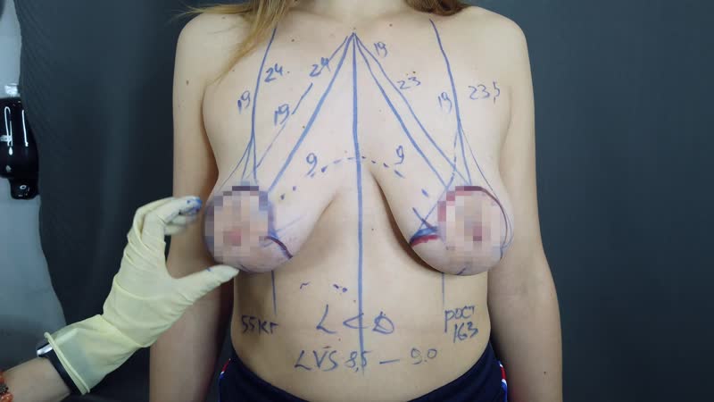 Разметка перед подтяжкой груди без имплантов