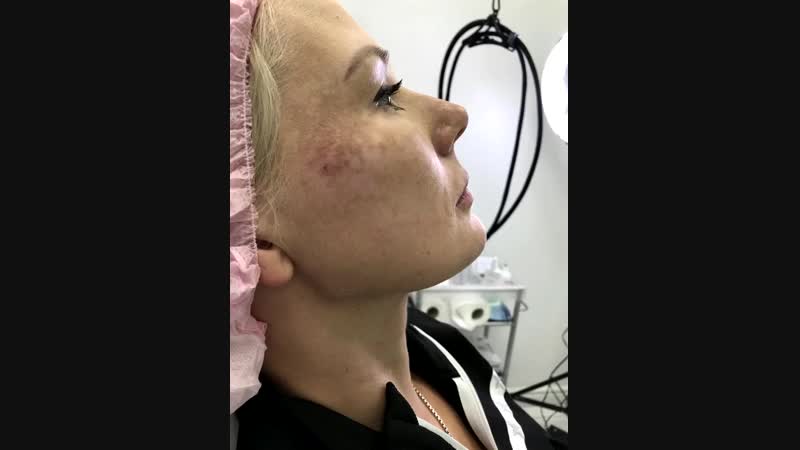 Аугментация углов нижней челюсти и подбородка препаратом на основе гиалуроновой кислоты врач косметолог татьяна викторовна