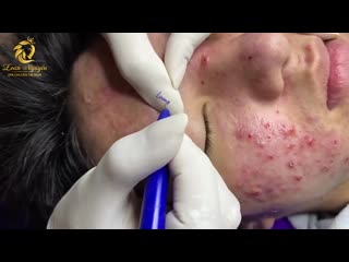 Угри, комедоны, забитые поры