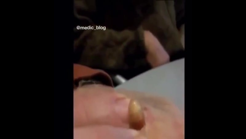 Как появляются личинки овода в человеческом организме?