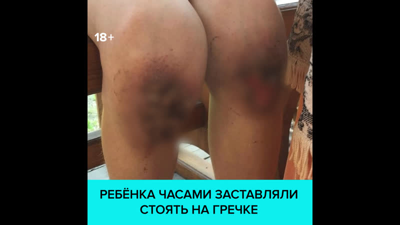 В омске мальчика в качестве наказания ставили на гречку, она вросла в кожу москва 24