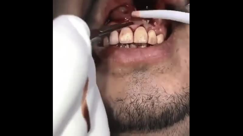 Биопсия кисты в верхней челюсти