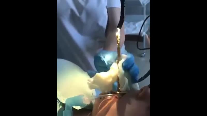 В дагестане медикам пришлось доставать змею из желудка женщины рептилия заползла в рот спящей девушке