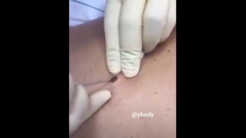 Удаление родинки