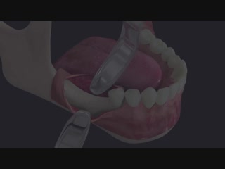 Bioner implante short dm fresado secure