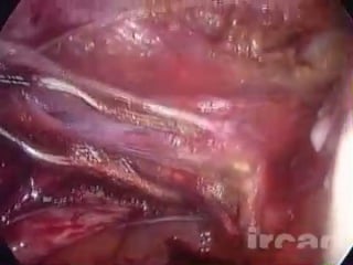 Laparoscopic hysterectomy for a large fibroid uterus with adnexectomy and suturing laparoscopic surgery on the e surgical re