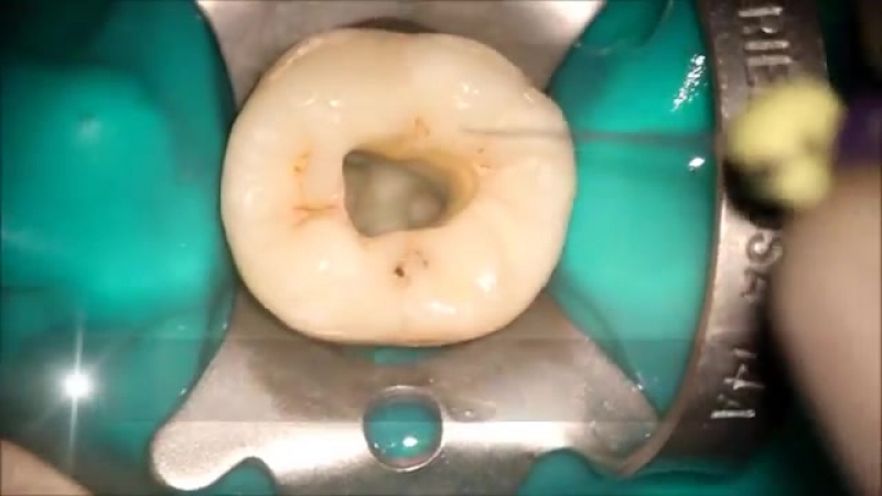 Second mandibular molar endodontic acces cavity