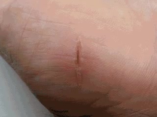 Стадии заживления раны