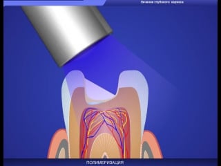 Глубокий кариес