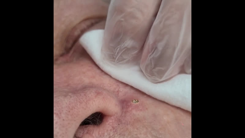 Удаление атеромы лазером в мц лазер+эстетика