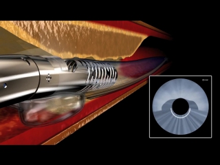 Device that enables to see inside arteries to treat blockage