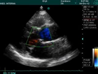 Mitral valve prolapse echocardiography doppler