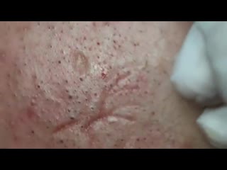 Сотни черных точек на лбу