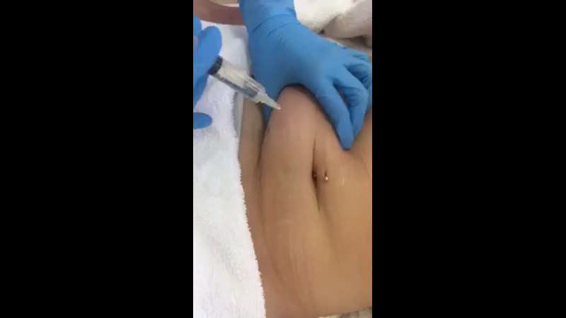 Липолитики