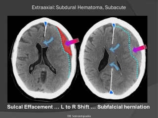 Subdural hematoma (vumedi) by dr james smirniotopoulos, uniformed services university, bethesda, md