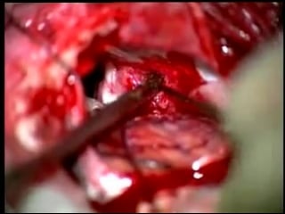 82 удаление менингиомы мосто мозжечкового угла