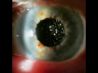 Астероидный гиалоз