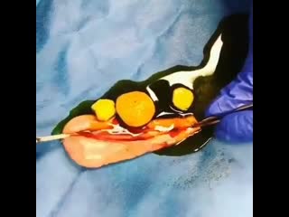 Желчный пузырь с камнями