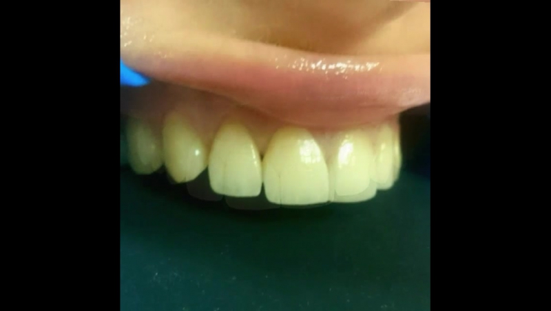 Эстетическая реконструкция верхних резцов 4 винирами из прессованной керамики ops e max