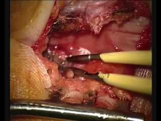 53 декомпрессия срединного нерва (карпальный синдром) 3